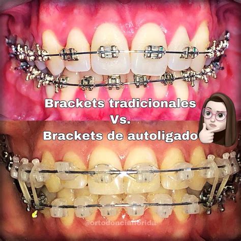 ¿Cuál es la diferencia entre los brackets metálicos y los brackets 